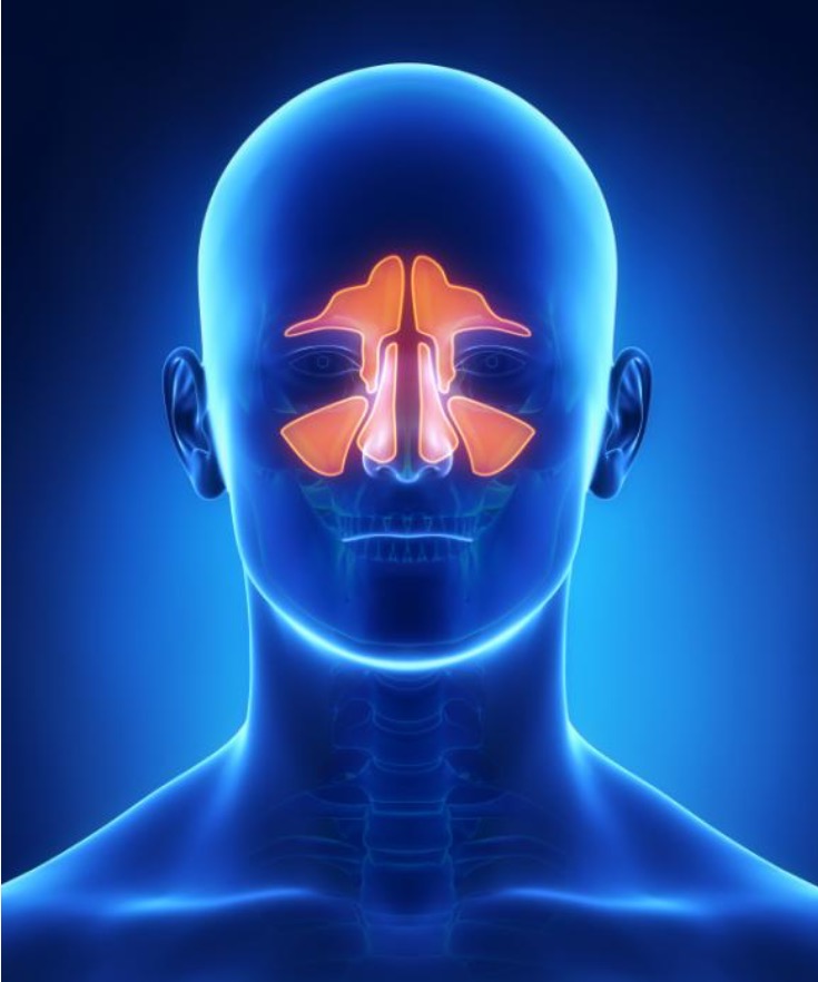Sinusitis what is